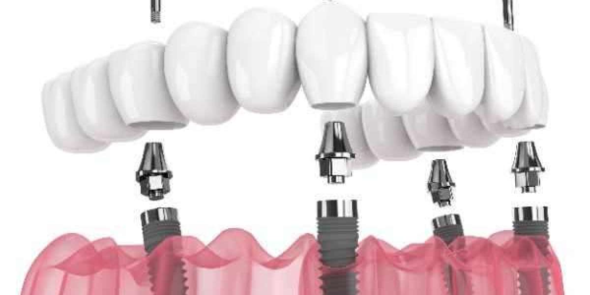 All on 6 Dental Implants: Recovery Timeline and Aftercare Tips